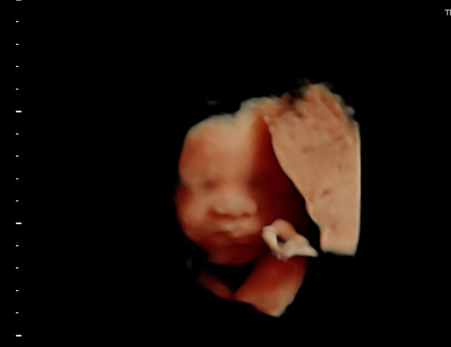 3D ultrasound image at 29 weeks
